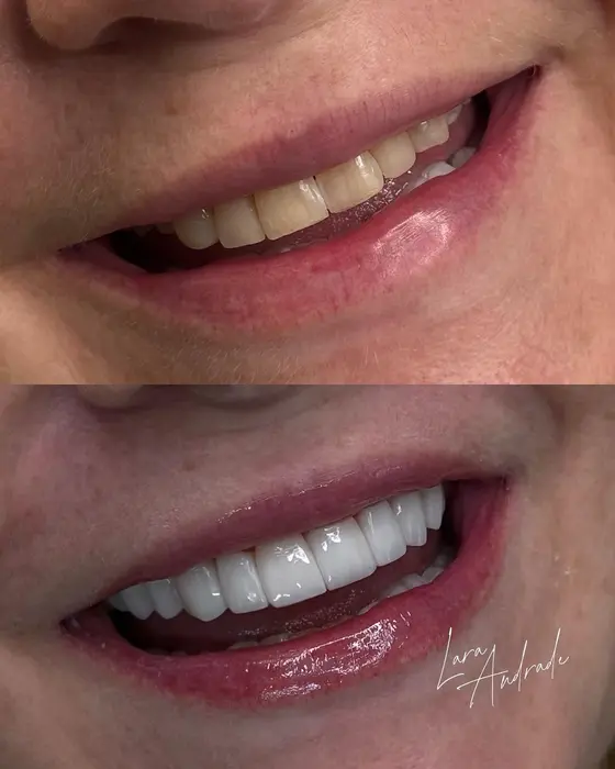 Resultado antes e depois 2