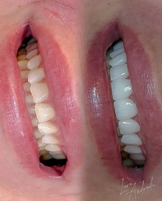 Resultado antes e depois 6